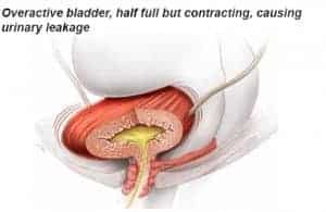 Bladder Contractions
